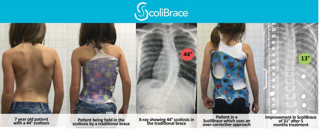 ScoliBrace Custom Braces Treating Scoliosis Patients Of All, 42% OFF