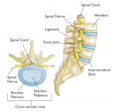 What Is a Herniated Disc and What Can You Do If You Have One