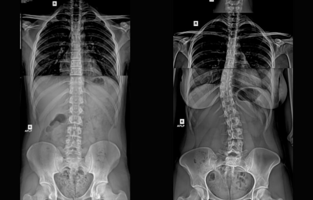 normal-spine-versus-scoliosis